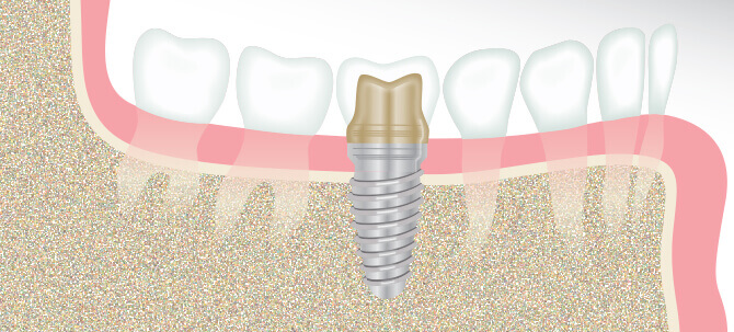 dental implants in cary - diagram
