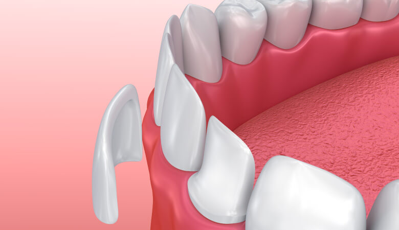 illustration of veneer being place onto tooth