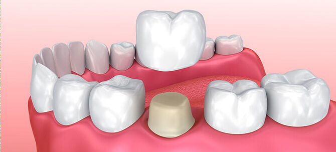 illustration of a dental crown