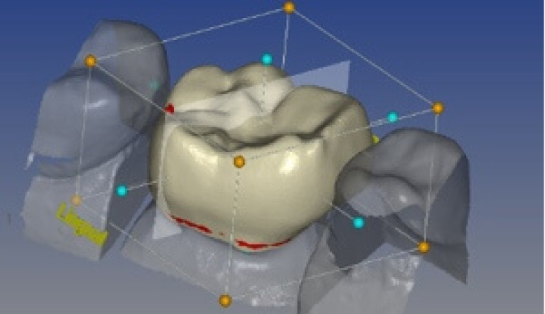 3d dental crowns technology