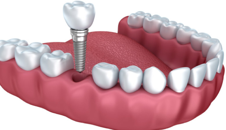 model of a dental implant