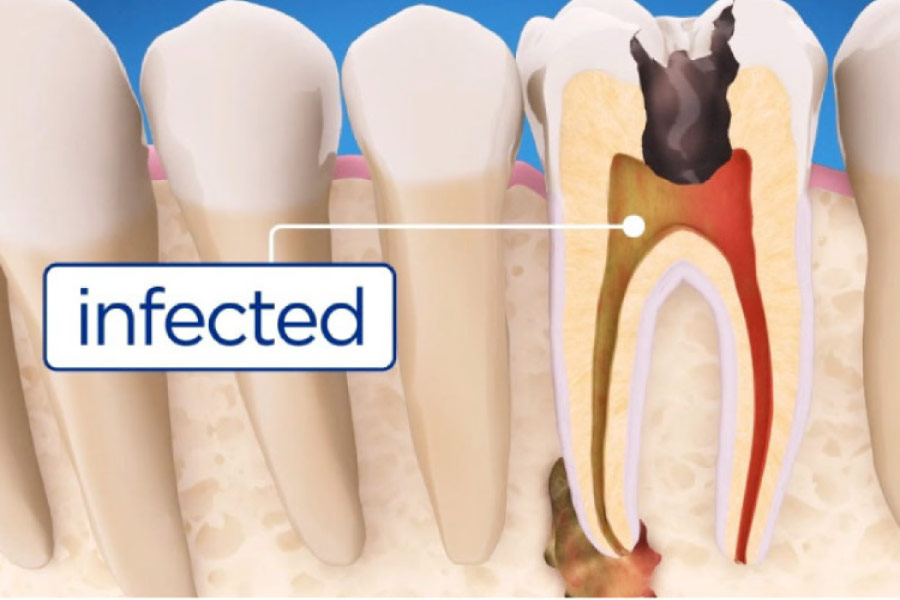 root canal infection illustration